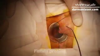 فیام عمل جراحی فیستول مقعدی - درمان لیزر