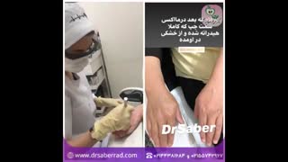 درمااکسی تکنیک نوین درمان خشکی پوست لیزر فرکشنال
