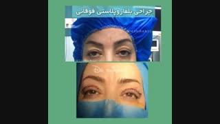 فیلم واقعی خانمی که جراحی بلفاروپلاستی انجام داده است