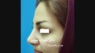 فیلم رینوپلاستی