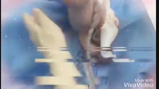 زایمان سزارین