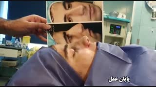 عمل بینی استخوانی توسط دکتر امید ابراهیمی بهترین جراح بینی استخوانی در تهران