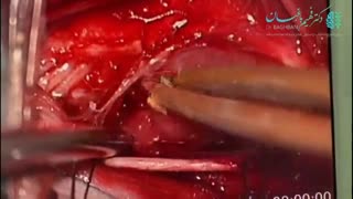 جراحی تومور خوش خیم نخاع گردن