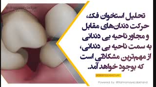 عوارض عدم جایگزینی دندان از دست رفته و درمان‌های احتمالی مورد نیاز را در این ویدیو ملاحظه فرمایید | دکتر سپیده دادگر