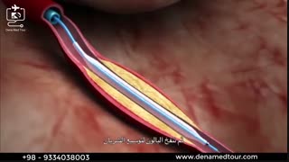 القسطرة التداخلیة للشرایین التاجیة