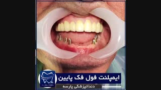 ایمپلنت فول فک پایین