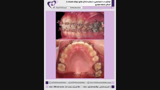 بیمار دارای سه دندان نهفته بود | دکتر فاضل فیروزی