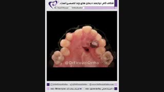 شکاف کام نیازمند درمان های چند تخصصی است | دکتر فاضل فیروزی
