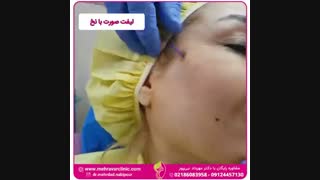 لیفت صورت با نخ