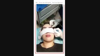 فیلم نمونه واقعی کاشت ابرو