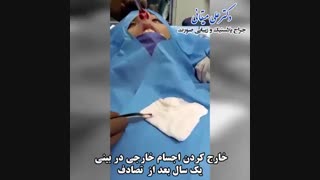 فیلم خارج کردن اجسام خارجی از بینی