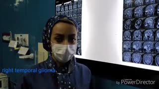 تومور گلیوم تمپورال راست