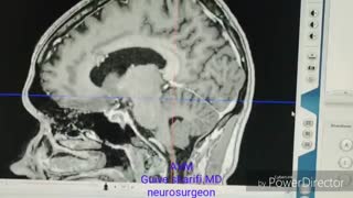 کلافه عروقی شریانی وریدی