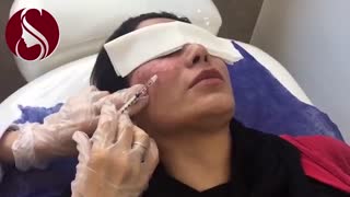 رفع لک ملاسما مزوتراپی