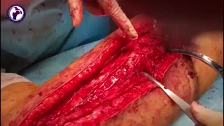 ترمیم جوش نخوردگی استخوان