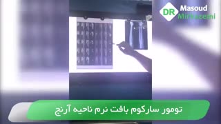 فیلم جراحی تومور سارکوم آرنج