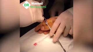 فیلم کورتاژ تومور غضروفی