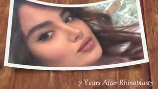 7 سال بعد از جراحی بینی | دکتر شهریار یحیوی