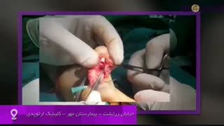 ترمیم پارگی تاندون فلکسور انگشت شست دست در خانم جوان