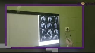 عمل جراحی پروتز شانه در خانم ۸۸ ساله دارای شکستی سر استخوان بازوی چپ