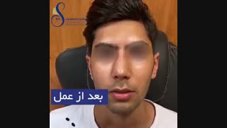 جراحی زیبایی بینی مردانه