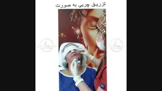 جوانسازی صورت با تزریق چربی به روش نانوفت درمان ریزش مو