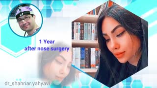 یکسال بعد از جراحی بینی توسط دکتر شهریار یحیوی