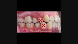 تاثیر ارتودنسی روی لب ها | دکتر داودیان تزریق ژل