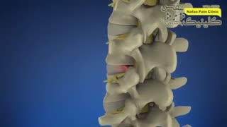 درمان دیسک کمر با لیزر ترمیم ونیر