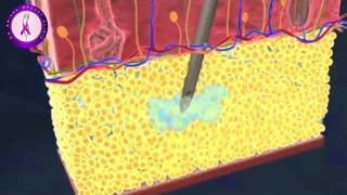 لیپوساکشن ران