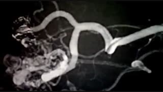 امبولیزاسیون ناهنجاری شریانی وریدی مغز AVM