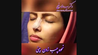 نحوه چسب زدن بینی توسط دکتر رضا رفیع