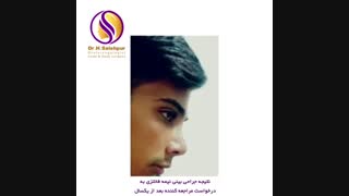 عمل بینی مردانه