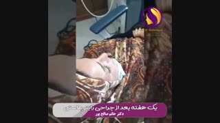 یک هفته بعد از عمل بینی