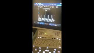 تشخیص تنگی شدید شریان کاروتید توسط سونوگرافی داپلر عروق گردن