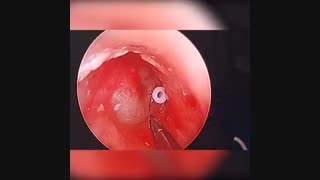 عمل قرار دادن لوله تهویه در گوش با روش آندوسکوپ