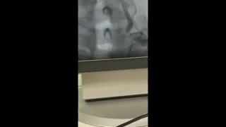 آنژیوگرافی تنگی شدید شریان ورتبرال در محل جدا شدن از شریان سابکلاوین