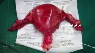 فیلم عمل جراحی هیسترکتومی