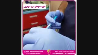 تقویت موی سر با مزوتراپی