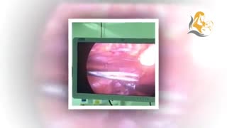 لاپاراسکوپی چسبندگی شدید روده و رحم و هیدروسالپنکس