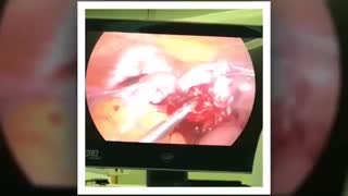 لاپاراسکوپی هیدروسالپنکس چسبندگی شدید