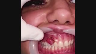 برداشتن ضایعه دندانی