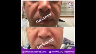 تزریق فیلر به گونه
