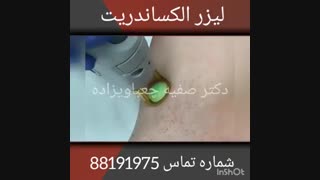 فیلمی از نحوه عملکرد لیزر موهای زائد