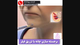 برجسته سازی چانه با تزریق فیلر