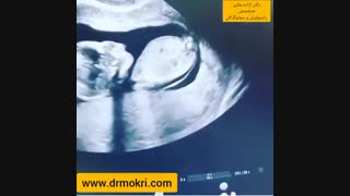 آیا سونوگرافی تعیین تاریخ بارداری جنسیت بچه را مشخص می‌کند؟