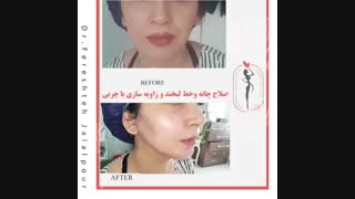فیلم اصلاح چانه و خط لبخند و زاویه سازی با چربی