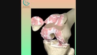 فیلم تعویض مفصل زانو