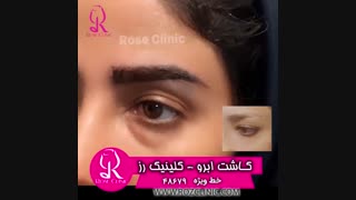 فیلم کاشت ابرو | کلینیک رز | 02148679 | شماره 220
