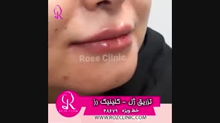 فیلم تزریق ژل | کلینیک رز | 09104440228 | شماره 188